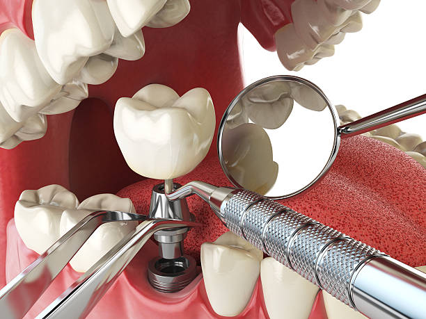 Best Lost Filling or Crown Replacement in Cortez, FL